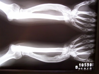 Novas descobertas no NMT - Síndrome de Madelung