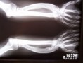 Novas descobertas no NMT - Síndrome de Madelung